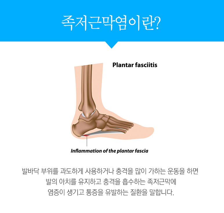 족저근막염.jpg